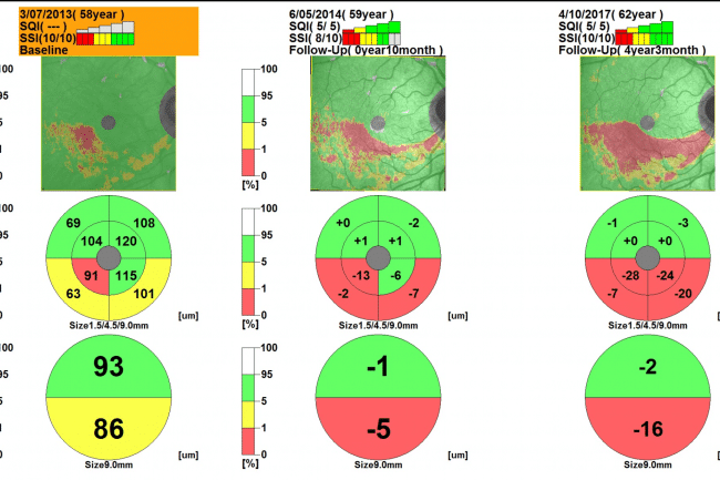 OCT case example results