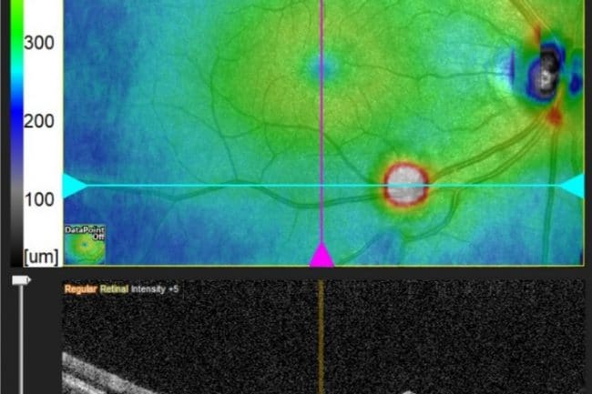 An OCT scan into the layers of the same lesion.