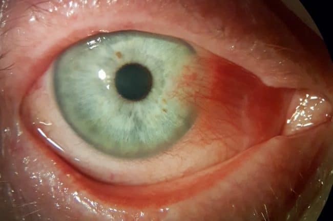 Regular photo of a pterygium