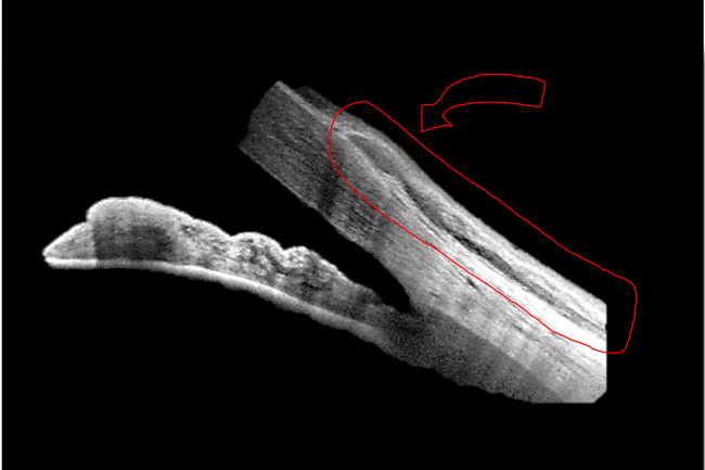 OCT scan of a pterygium